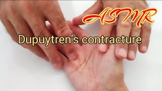 ASMR Hand massageDupuytrens contracture therapy [upl. by Davis]