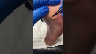 Watch this significant corn removal transformation by our expert podiatrist FootCare PodiatryMagic [upl. by Inavoig474]