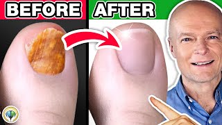 1 Absolute Best Toenail Fungus Cure [upl. by Wyck]