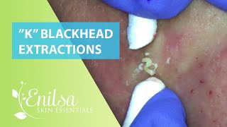 Blackheads Extractions “K’s” 8th Treatment [upl. by Llereg]