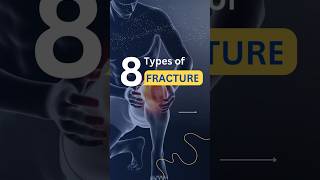 Types of bone fractureMedical Minute bones fracture bonefracture anatomy shorts medical [upl. by Fagen121]