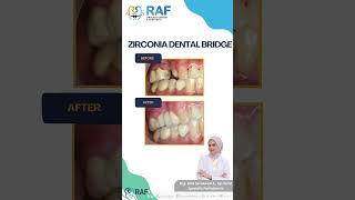 ZIRCONIA DENTAL BRIDGE zirconiacrown dentalbridge [upl. by Ayikan]