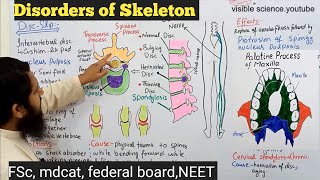 deformities of skeleton class 12  disorders of human skeleton class 12 [upl. by Reisch]