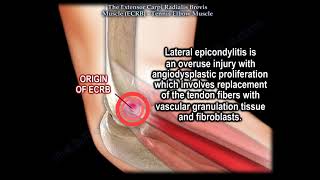 Tennis Elbow Muscle Extensor Carpi Radialis Brevis Everything You Need To Know Dr Nabil Ebraheim [upl. by Tyoh176]