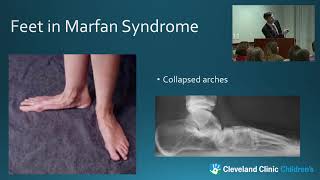 Musculoskeletal Challenges in Marfan Syndrome and the Role of Physical Therapy [upl. by Lehcer70]