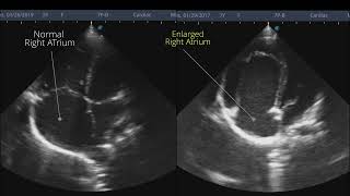 Ebsteins anomaly  Point of Care ECHO  Short Video [upl. by Berri]