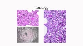 Molecular Profiling of Myelodysplastic Syndromes [upl. by Nessy]