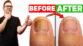 BEST Toenail Fungus Treatment 2024 4 BIG SECRETS [upl. by Nonnahs]