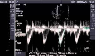 Point of Care Echo Stroke Volume Determination [upl. by Ruthie]