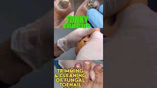 Part 2 Best of Callus Treatments Podiatry  Fungal Nail with Dried Abscess 🦶 Ingrown Nail Treatment [upl. by Hanikas667]