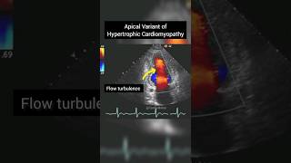 Apical Variant of Hypertrophic Cardiomyopathy on Echocardiography anatomy heart [upl. by Sesmar]