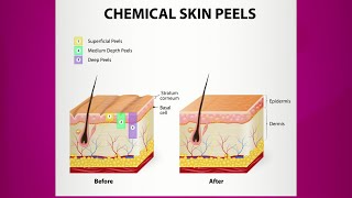 Chemical Peel Purpose amp Types [upl. by Aynatan]