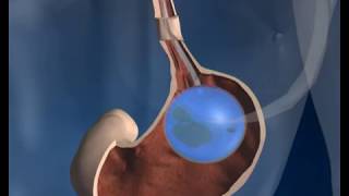 Gastric Balloon Surgery  how it works  Phoenix Health [upl. by Lyndel]