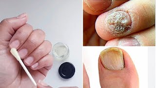 Cómo eliminar LOS HONGOS en las uñas de la mano Remedio sin ajo [upl. by Llerraj718]