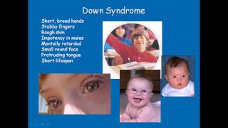 Chromosomal disorders [upl. by Alatea]