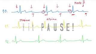 EKG 6 by Coiled CZECH síňová a komorová tachykardie flutter síní a komor fibrilace síní a komor [upl. by Ireva]