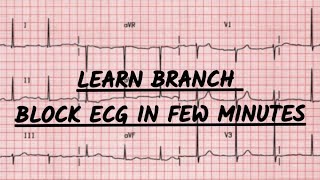 Bundle branch block ecg made easy  lbbb ecg explanation [upl. by Aneehsat]