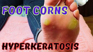 Satisfying foot corns removal Hyperkeratosis [upl. by Worthington]