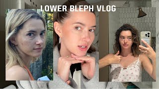 I got plastic surgery Lower blepharoplasty vlog [upl. by Nikolia326]