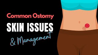 Common Ostomy Skin Issues amp Management [upl. by De Witt]