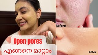 മുഖത്തെ കുഴികൾ മാറ്റി SKIN BRIGHT ആകാൻ  💯 Natural Home Remedy [upl. by Lamaaj19]