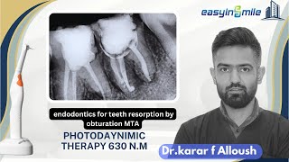 Endodontic Treatment for teeth resorption amp AClinical Case with MTA and Bioceramicpdt630 [upl. by Tressia561]