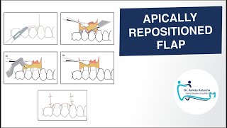 APICALLY REPOSITIONED FLAP PERIODONTAL FLAP SURGICAL TECHNIQUE DR ANKITA KOTECHA [upl. by Euqnom]