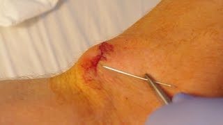 How To Give Yourself Stitches Sutures [upl. by Brendis145]