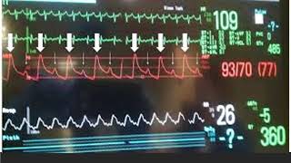 Heart rate Pulse rate amp Pulse deficit Identify real problem versus issue with cardiac monitor [upl. by Anoli]