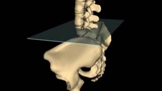 Right on Left Sacral Torsion amp Anterior Innominate Correction A Unique Approach [upl. by Aliakam]