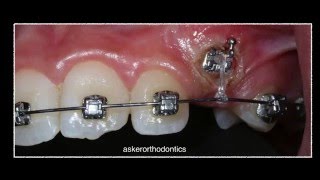 Exposure of unerupted canine using diathermy and orthodontic traction by Dr Amr Asker [upl. by Corell]