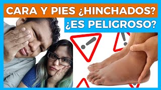 RETENCION DE LIQUIDOS 😱 PIESCARAMANOS HINCHADAS 🦶🏻🤚🏻💧Junica IRC [upl. by Ifill]