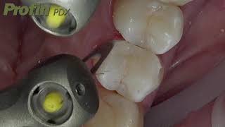 Dentatus Profin PDX Handpiece in action [upl. by Nahtal]