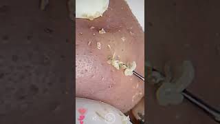 Skincare  Blackheads Removal 099 skincare skincare blackheads blackheads [upl. by Htyderem]