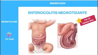 NEONATOLOGÍA  ENTEROCOLITIS NECROTIZANTE  ENARM 2024 [upl. by Vashtee]