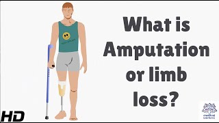 What is Amputation or Limb Loss [upl. by Lednahc]