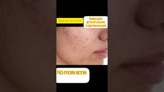 duac acne gel before and afterbest acne treatment by dermatologistacnetreatment trendingvideo [upl. by Eilema]