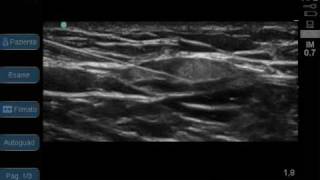 lateral cutaneous femoral nerve block by Mario Tedesco [upl. by Rozelle]