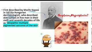 Kaposi Sarcoma lecture Pathogenesis clinical features histopathology EVERYTHING you need to know [upl. by Adiraf487]