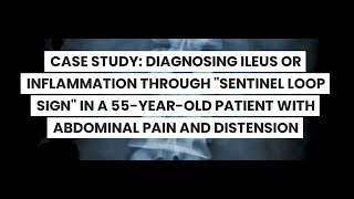 CASE STUDY DIAGNOSING ILEUS OR INFLAMMATION THROUGH quotSENTINEL LOOP SIGNquot [upl. by Aruasor]