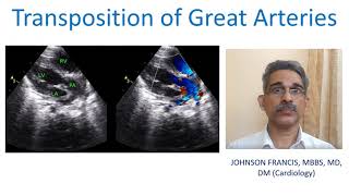 Transposition of the Great Arteries TGA [upl. by Ahsemal]