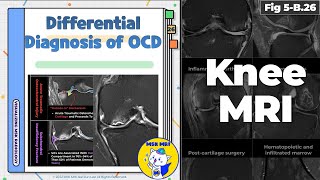 Fig 5B26 Differential Diagnosis of Osteochondritis Dissecans [upl. by Erich]