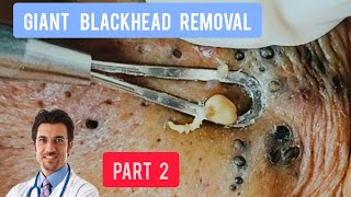 Massive blackhead removal inside a dermatology clinic  DrAMAZINGSKIN [upl. by Delphine12]