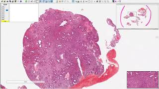 Endometrial hyperplasia without atypia Atypical endometrial hyperplasia Endometrioid carcinoma [upl. by Knight533]