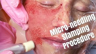 DERMASTAMP Needling Medical Microneedling Procedure [upl. by Irby534]