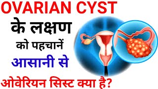 Ovarian Cysts in women  symptomsओवेरियन सिस्ट के लक्षण को पहचानें आसानी से  Ovarian cyst kya hai [upl. by Hakeem]