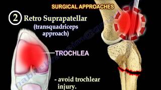 Intramedullary Nailing Proximal Tibial Fractures  Everything You Need To Know  Dr Nabil Ebraheim [upl. by Livvy]