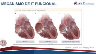Regurgitação Tricúspide Funcional Mecanismo e o Papel da Imagem [upl. by Ronny]