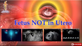 Fetus NOT in Utero [upl. by Niuqram]