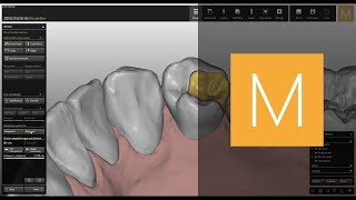 InlaysOnlaysVeneers software module of ZirkonzahnModellier  ZirkonzahnSoftware [upl. by Ettevol237]